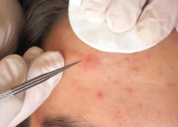Best Pimple Spot Treatment