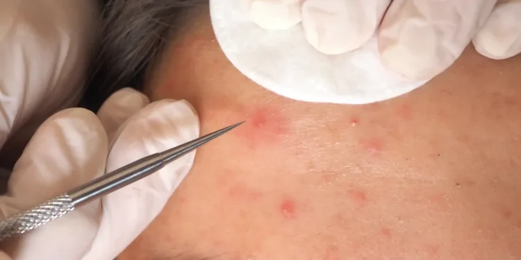 Best Pimple Spot Treatment