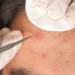 Best Pimple Spot Treatment