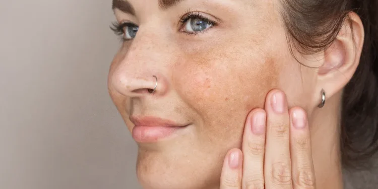Remove Dark Spots on Face