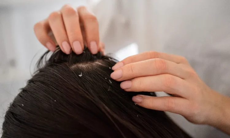 Best Remedies for Dandruff Treatment at Home
