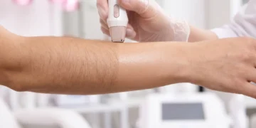 Permanent Laser Hair Removal