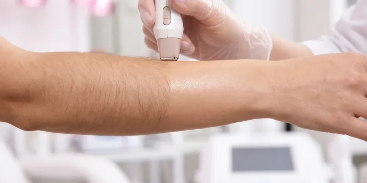 Permanent Laser Hair Removal