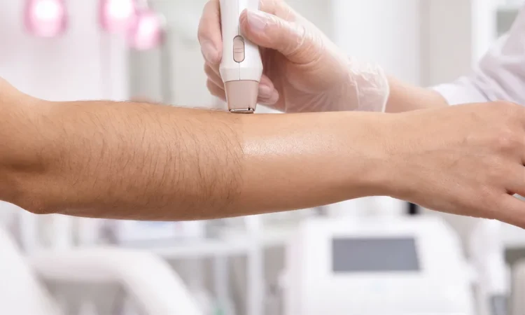 Permanent Laser Hair Removal