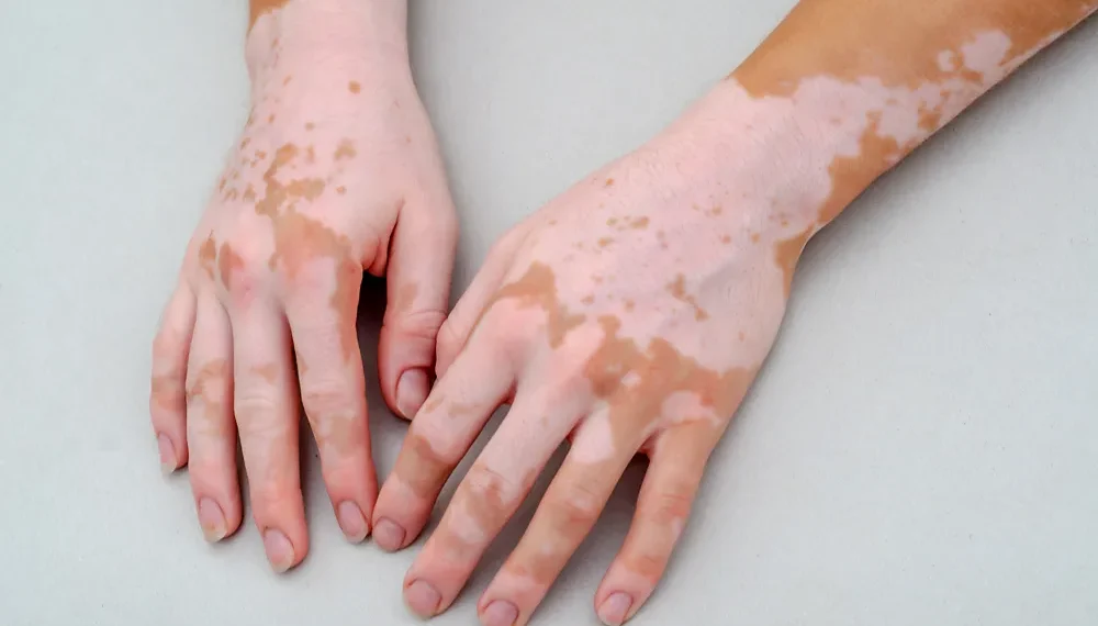 Vitiligo Treatment in Mumbai