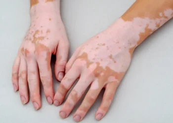 Vitiligo Treatment in Mumbai