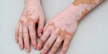 Vitiligo Treatment in Mumbai