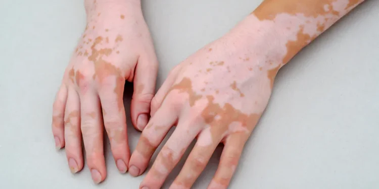 Vitiligo Treatment in Mumbai