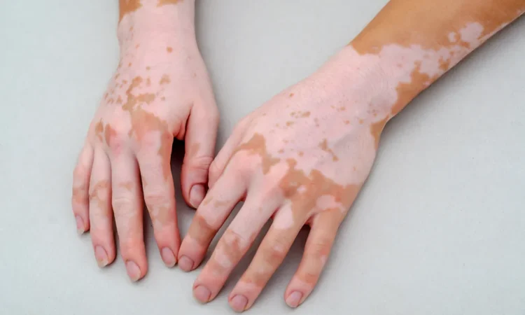 Vitiligo Treatment in Mumbai