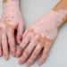 Vitiligo Treatment in Mumbai