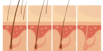 ingrown hair treatment at home