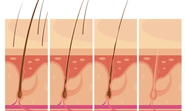 ingrown hair treatment at home
