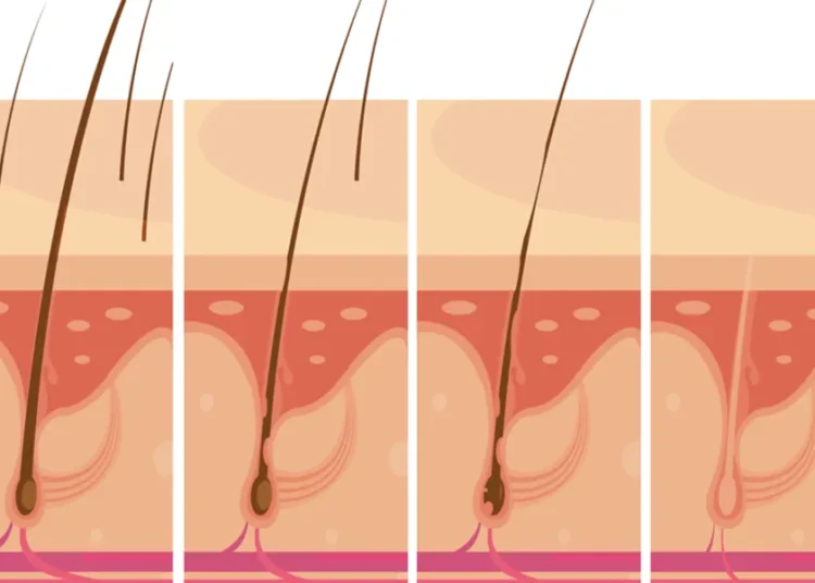 ingrown hair treatment at home