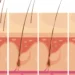 ingrown hair treatment at home