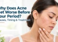 Acne Before Your Period Causes