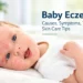 Baby Eczema Care Guide