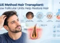FUE Method Hair Transplant