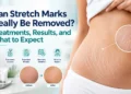 Stretch Mark Treatment