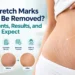 Stretch Mark Treatment